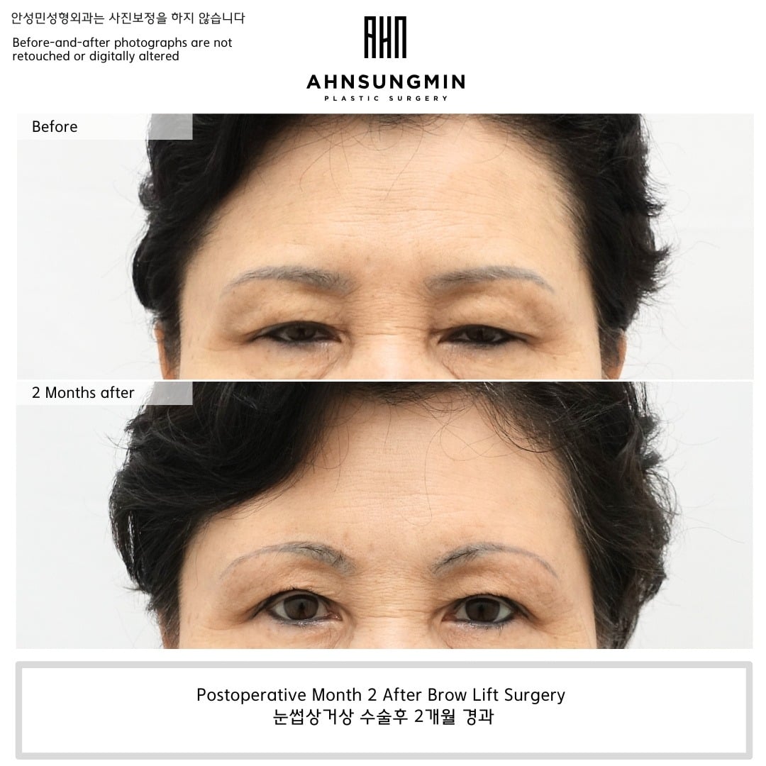 Brow lift – 2 months – before and after photo, Dr. Ahn Sung Min, Seoul Korea