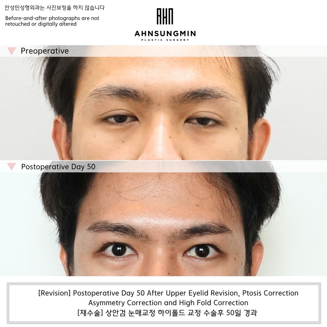 Revision ptosis correction with asymmetry and high-fold correction – day 50 – before and after photo, Dr. Ahn Sung Min, Seoul Korea