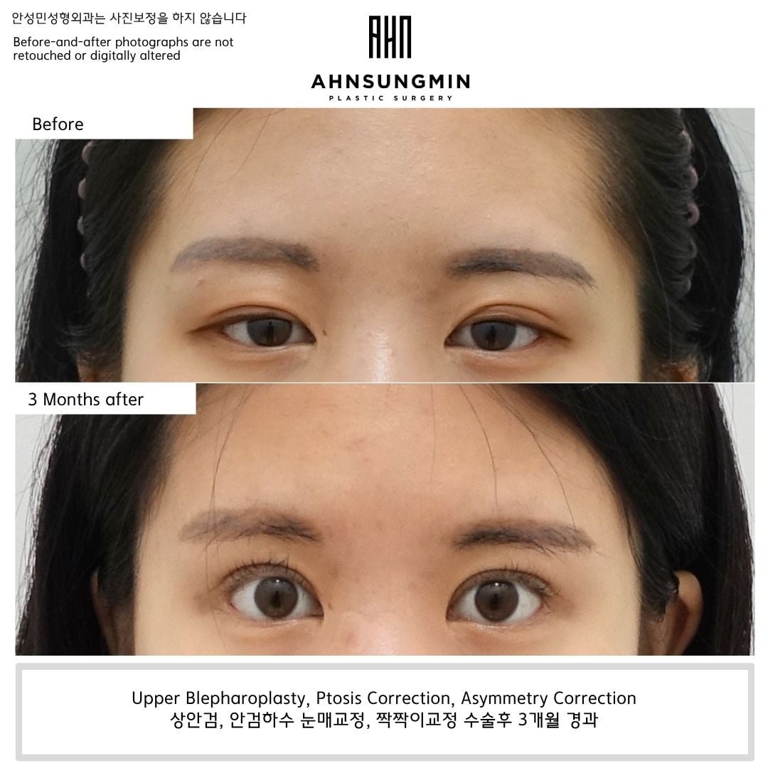 Upper blepharoplasty with ptosis and asymmetry correction – 3 months – before and after photo, Dr. Ahn Sung Min, Seoul Korea