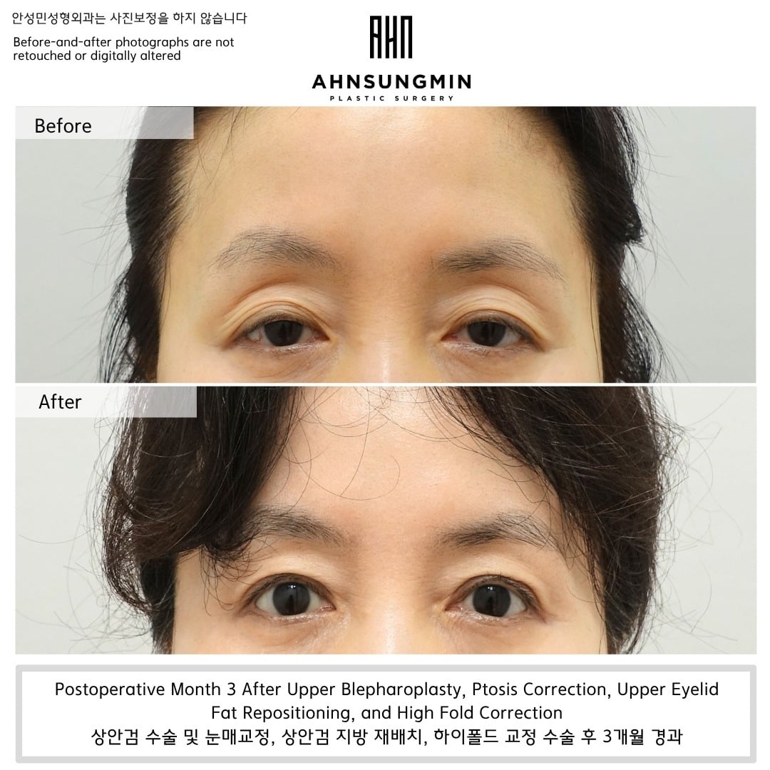 Upper blepharoplasty with ptosis correction, fat repositioning and high-fold correction – 3 months – before and after photo, Dr. Ahn Sung Min, Seoul Korea