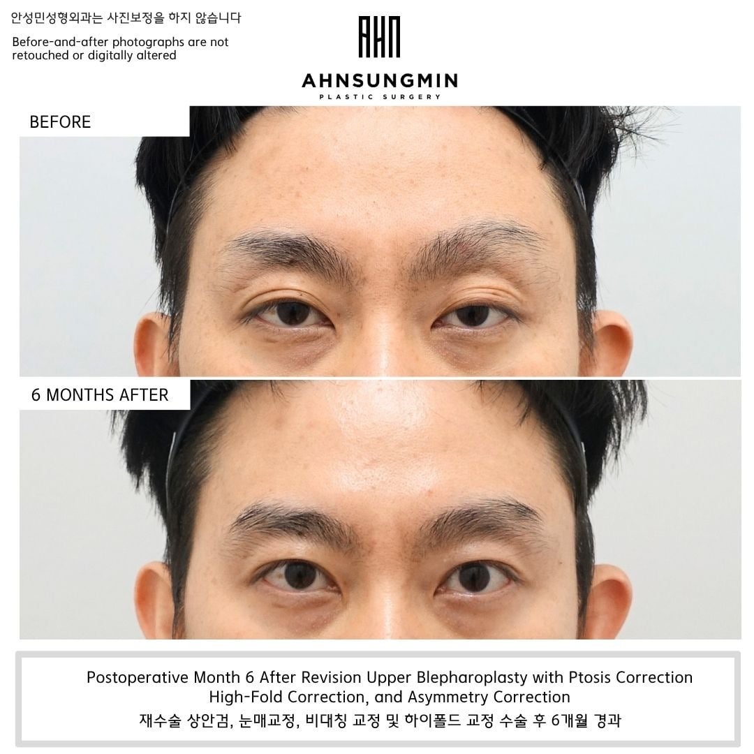 Revision upper blepharoplasty with ptosis, high-fold and asymmetry correction – 6 months – before and after photo, Dr. Ahn Sung Min, Seoul Korea
