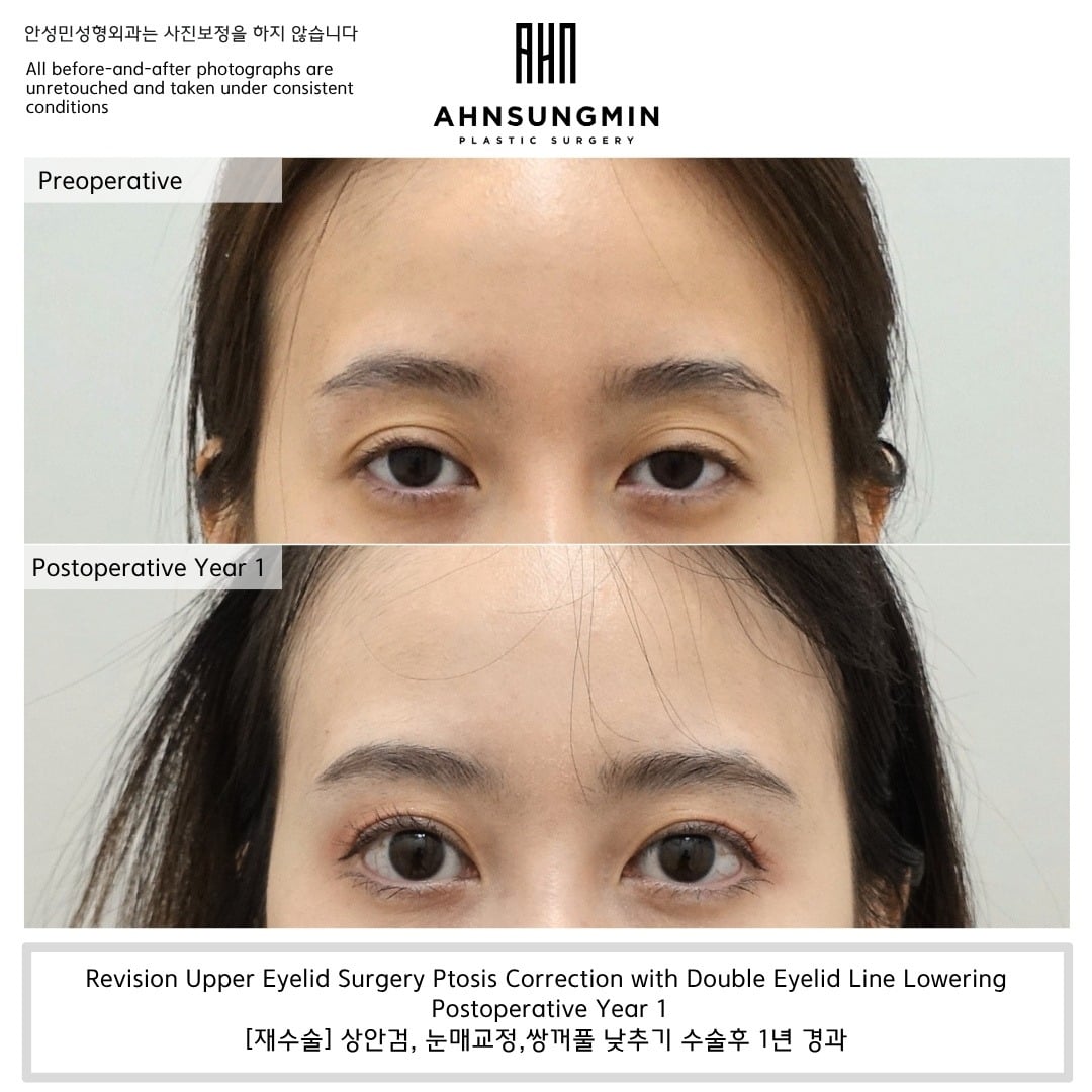 Crease lowering with ptosis correction – 1 year – before and after photo, Dr. Ahn Sung Min, Seoul Korea