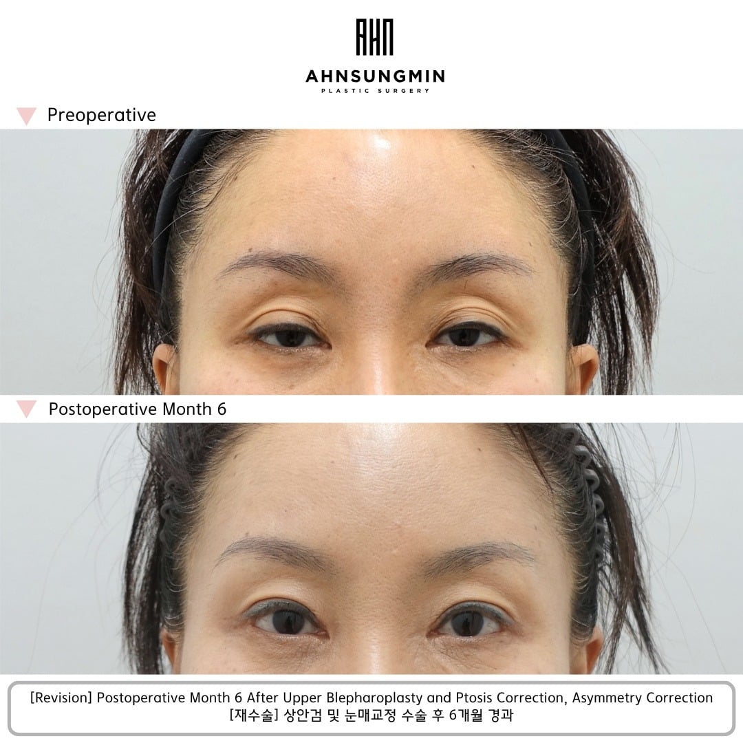 Revision with ptosis and asymmetry correction – 6 months – before and after photo, Dr. Ahn Sung Min, Seoul Korea