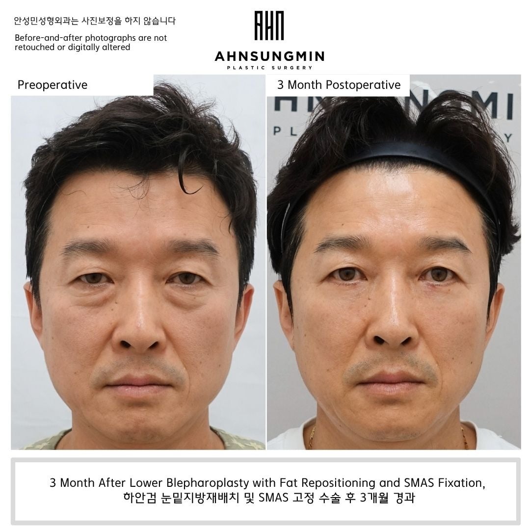 Male lower blepharoplasty with fat repositioning and SMAS fixation – 3 months – before and after photo, Dr. Ahn Sung Min, Seoul Korea