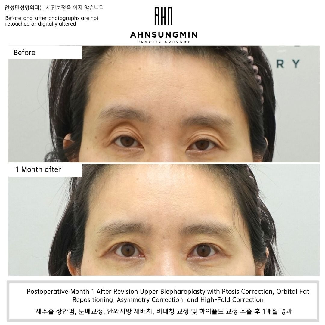 Revision with orbital fat repositioning, asymmetry and high-fold correction – 1 month – before and after photo, Dr. Ahn Sung Min, Seoul Korea