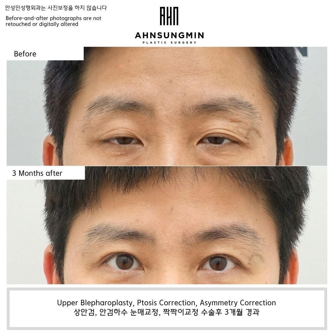 Upper blepharoplasty with ptosis and asymmetry correction – 3 months – before and after photo, Dr. Ahn Sung Min, Seoul Korea