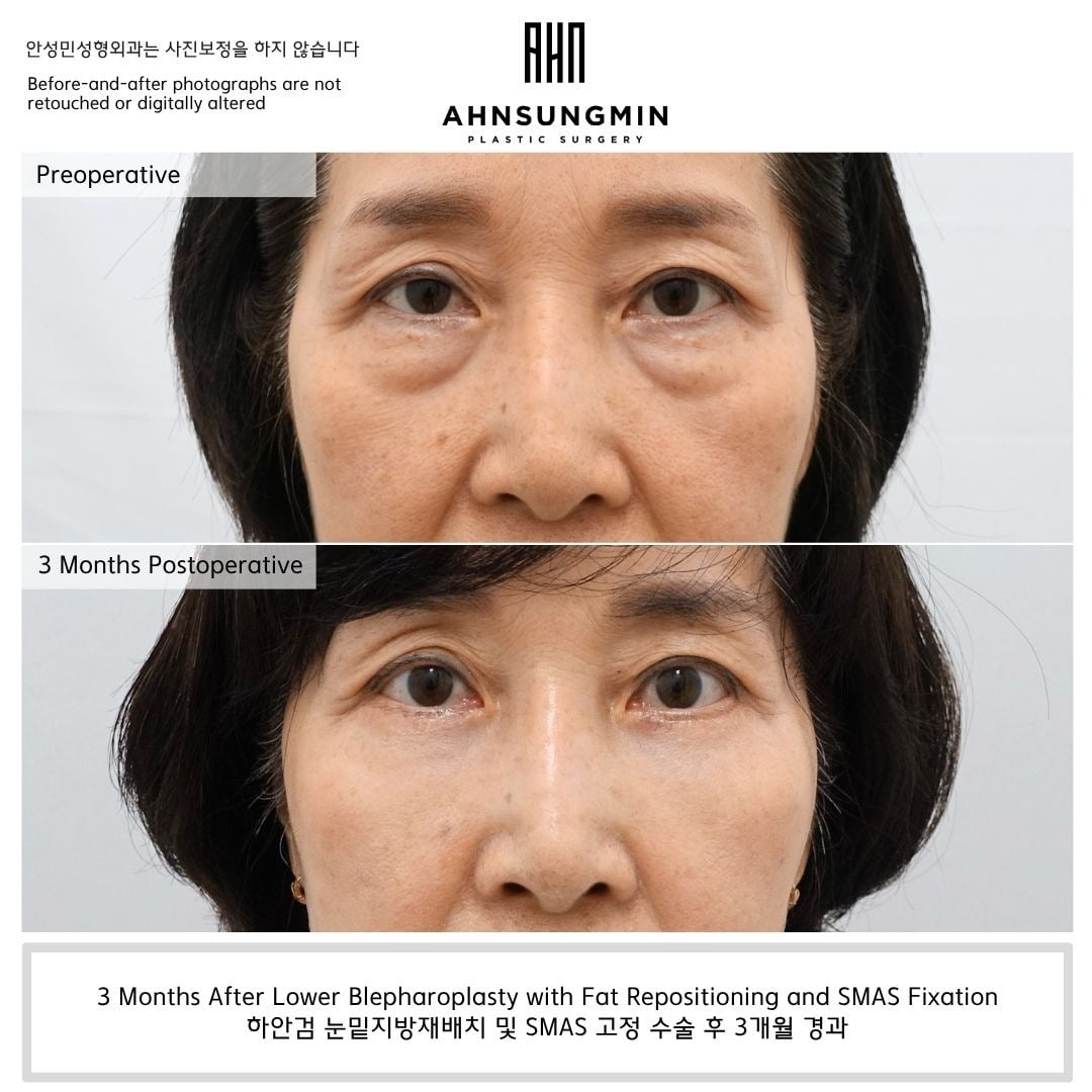 Lower blepharoplasty with fat repositioning and SMAS fixation – 3 months – before and after photo, Dr. Ahn Sung Min, Seoul Korea
