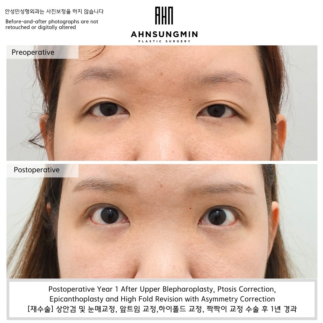 Epicanthoplasty combined with ptosis and high-fold correction – 1 year – before and after photo, Dr. Ahn Sung Min, Seoul Korea